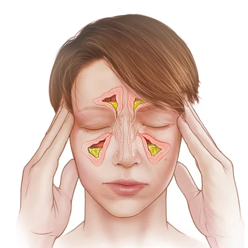 mcdc7_acute_sinusitis-8col